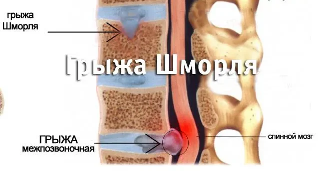 Грыжа Шморля