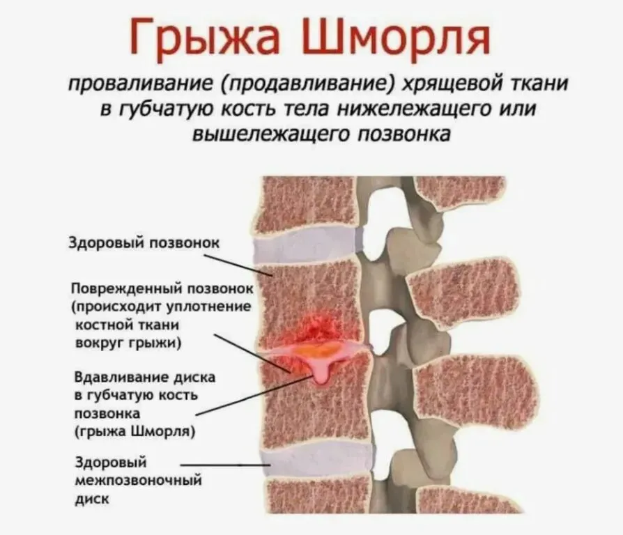 Грыжа Шморля