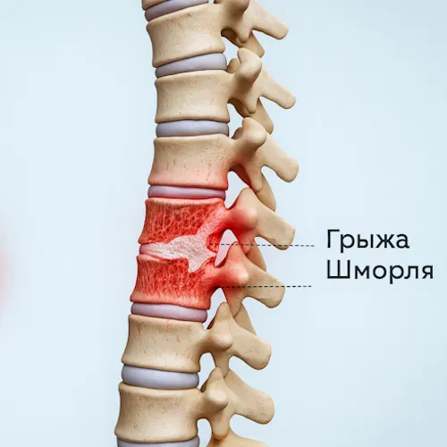 Грыжа Шморля