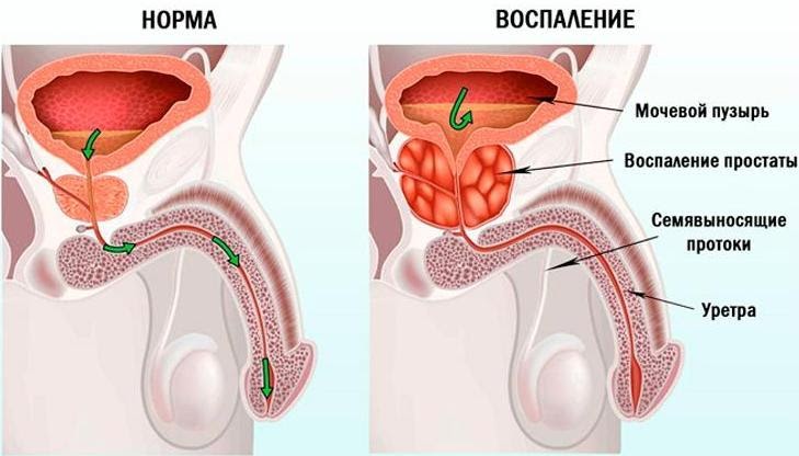 Простатит: в 90% случаев это не инфекция