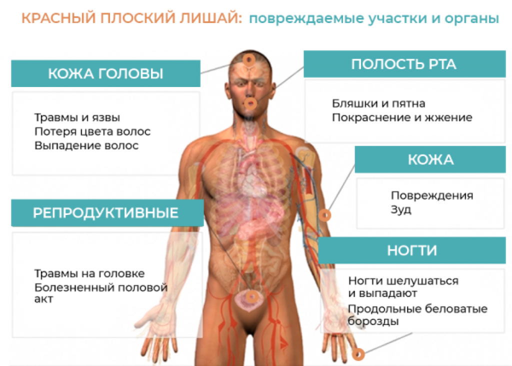 Красный плоский лишай